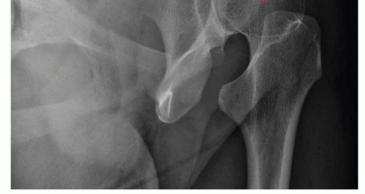 Illustration 6 for Restore Hip Health: Pelvic Osteotomy for Acetabular Dysplasia & CEA of Less