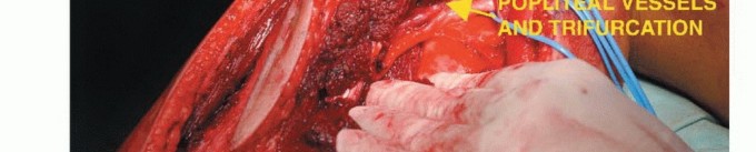 صورة طبية: استئصال أورام الشظية: دليل شامل للعلاج الحديث والحفاظ على الأطراف مع الأستاذ الدكتور محمد هطيف