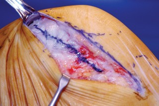 Illustration 20 for Unicompartmental Knee Arthroplasty: Master decisions with this b c figure guide.