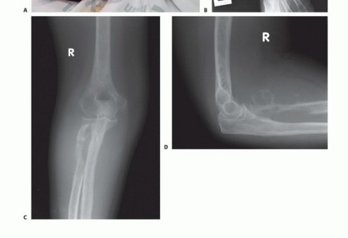صورة توضيحية لـ بتر الذراع فوق وتحت الكوع: متى ولماذا يصبح ضرورة طبية؟ دليل شامل من الأستاذ الدكتور محمد هطيف