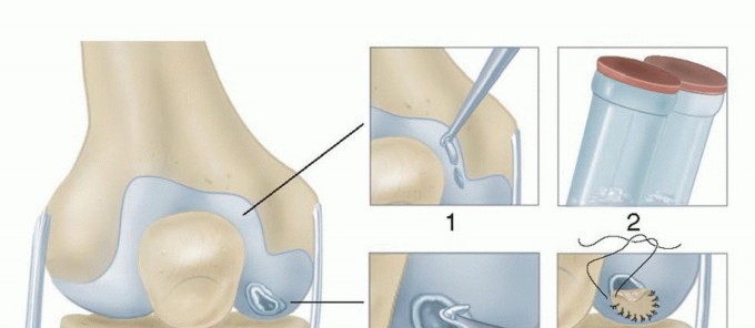 Is ACI Right for Your Articular Cartilage Lesion?