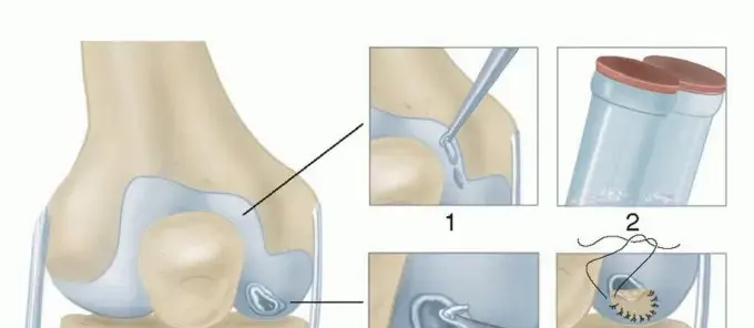 صورة توضيحية لـ زرع الغضاريف الذاتي (ACI): دليل شامل لاستعادة حركتك وحياتك بلا ألم في اليمن مع الأستاذ الدكتور محمد هطيف