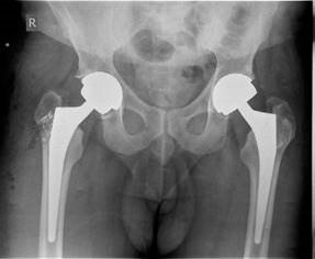 Illustration 4 for Is Your Femoral Head Affected? Understanding Hip Osteoarthritis
