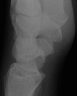 Illustration 17 for Christine M Kleinert Discussion: Solving Difficult Wrist Fractures