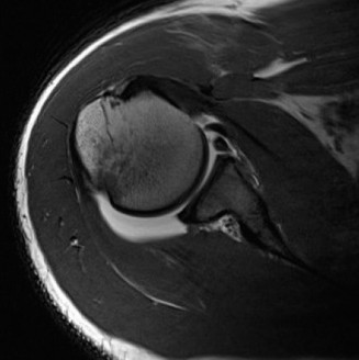 Illustration 2 for Anterior Instability: How Glenoid Bone Loss Shapes Treatment