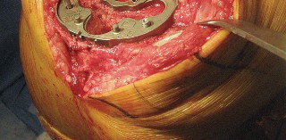 Illustration 52 for Posterior Stabilized Technique: Essential Insights for TKA Success