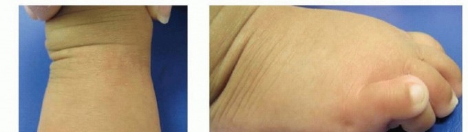 Illustration of overlapping fifth toe - Dr. Mohammed Hutaif