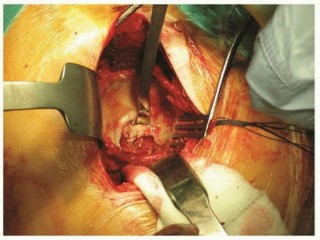 Cemented Acetabular Component: Achieving Optimal THA Stability