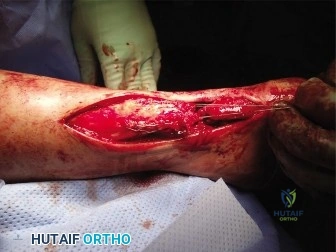 صورة توضيحية لـ نقل وتر الإبهام الطويل (FHL) لعلاج تمزق وتر العرقوب المزمن: دليل شامل للمرضى مع الأستاذ الدكتور محمد هطيف