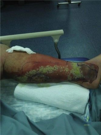 Illustration of necrotizing soft tissue - Dr. Mohammed Hutaif