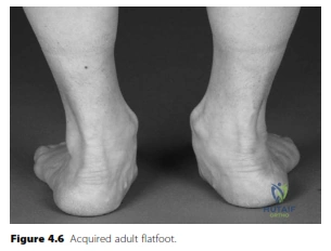 Illustration 1 for Unraveling Acquired Adult Flatfoot: Key Answers for Orthopedics