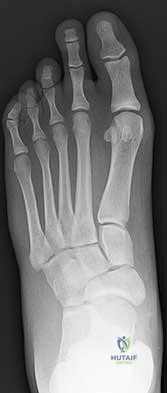 Illustration of osteogenesis imperfecta oi - Dr. Mohammed Hutaif