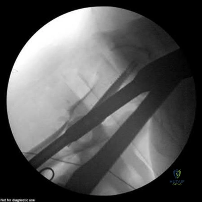 Illustration of due to a defect - Dr. Mohammed Hutaif