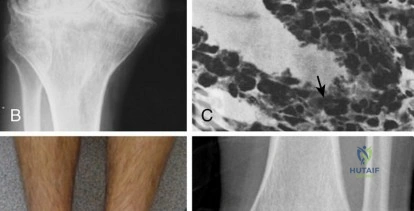 of Fracture Treatment: A Comprehensive Surgical Guide