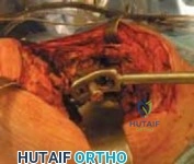 Illustration of uncemented tapered fluted - Dr. Mohammed Hutaif