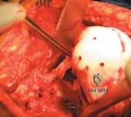 How to Choose the Right Orthopedic Surgeon