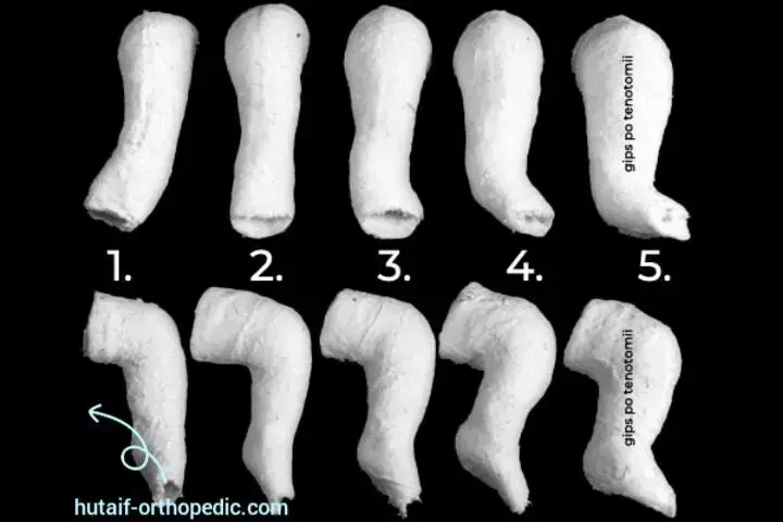 تثبيت كسور عظم الظنبوب البعيد بالصفائح والمسامير: دليل شامل