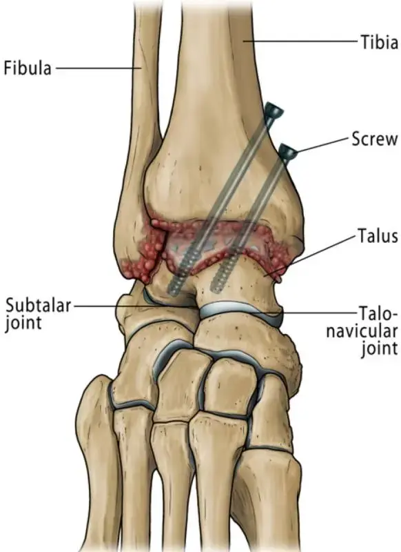 اكتشف: دليلك الشامل لأمراض القدم والكاحل عند البالغين