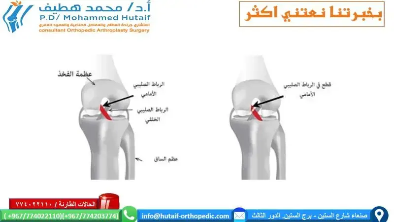 الشكل 13-1: يختلف وضع المسامير الهيكلية في عظم العضد باختلاف الموقع التشريحي. توضح العلاقة المتغيرة للحزم العصبية الوعائية بالعظم اختلاف مواقع تثبيت المسامير للأثلاث القريبة والوسطى والبعيدة. أ: الثلث القريب: أدخل مسمارًا نصفيًا من الجانب الوحشي للعظم، مع الحذر من اختراق القشرة الإنسية بعيدًا لتجنب تلف الحزمة العصبية الوعائية (الشريان العضدي والعصب الناصف). ب: الثلث الأوسط: ضع مسمارًا نصفيًا أماميًا، مع الحذر من اختراق القشرة البعيدة بعمق شديد لتجنب تلف العصب الكعبري. ج: الثلث البعيد: أدخل مسامير تثبيت عابرة من النقطة الإنسية إلى الوحشية، مع الحذر لتجنب العصب الزندي.