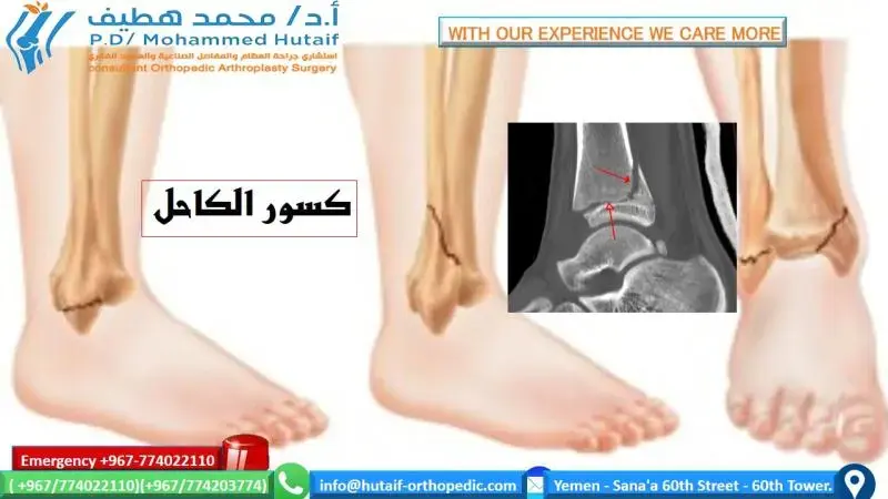 اكتشف: كسر رأس الكعبرة.. عرض حالة FRCS (جراحة العظام)