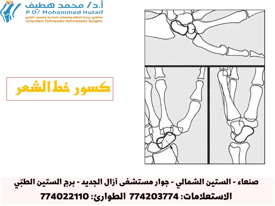 علاج كسور نهاية عظم العضد: تشخيص دقيق وخطوات شفاء متكاملة