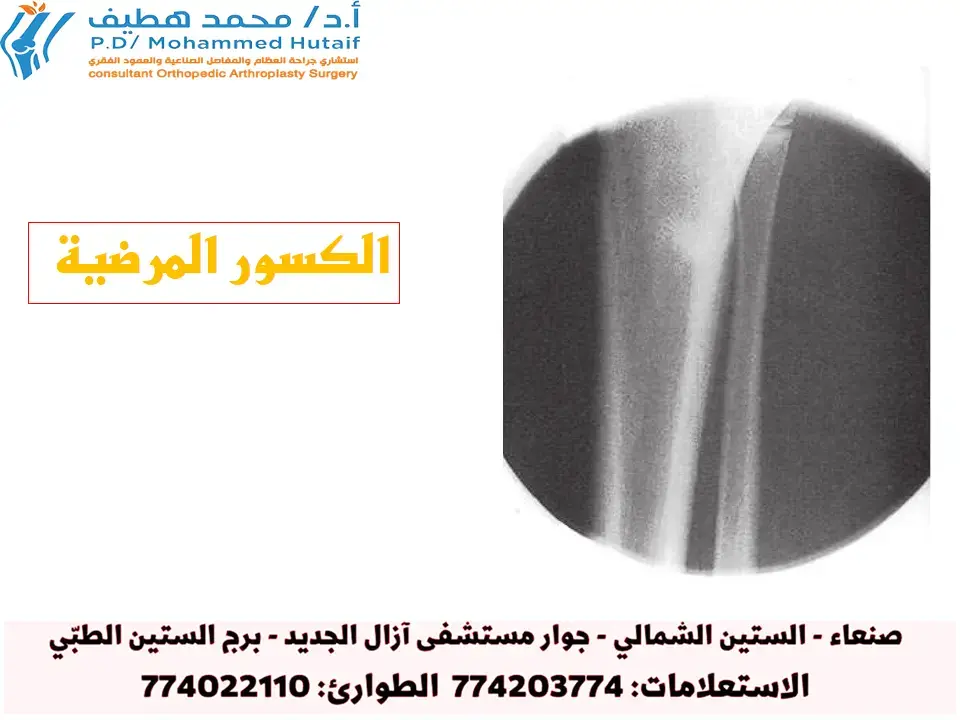 اكسر الخوف: دليلك الشامل لكسور الكاحل وعلاجها!