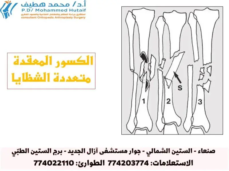 اكتشف: كسور العمود الفقري.. دليل شامل للتعافي!