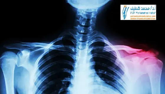 اكتشف: أسرار الخلع الكتفي العلوي | تشخيص وعلاج فعال