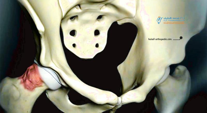 تخلص من ألم اصطدام الورك: دليلك الشامل للتشخيص والعلاج
