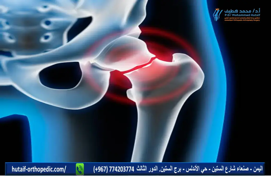 نقص عظام الحق: حلول ترميمية مبتكرة لمفصل الورك المعقد