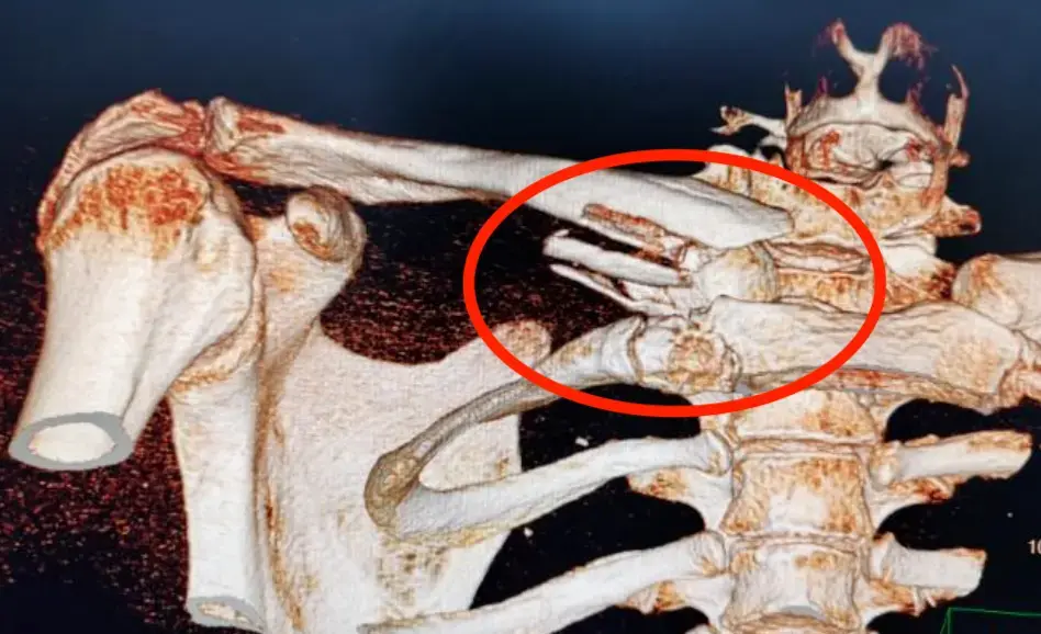 الشكل 1.19 نقص الكالسيوم الغذائي.