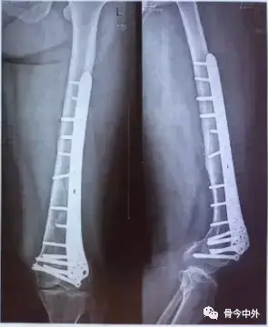 اتقن مسمار النخاع: دليلك الذهبي لاجتياز FRCS (Tr & Orth)