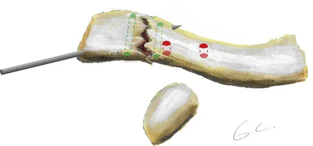 الشكل 2.6: ارتباطات عضلات الساعد (منظر أمامي وخلفي). الشكل 2.7: العضلات القابضة البطنية (السطحية والعميقة). الشكل 2.8: أربطة اليد والمفاصل بين السلامية. الشكل 2.9: المركب الغضروفي الليفي الثلاثي. الشكل 2.10: ارتباطات العضلات (منظر راحي وظهري). الشكل 2.11: حجرات الباسطة في الرسغ (1 إلى 6). الشكل 2.12: جهاز الباسطة. الشكل 2.13: تشريح النفق الرسغي. الشكل 2.14: غمد الوتر القابض.