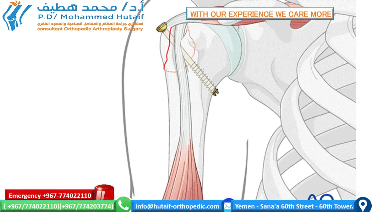 صورة توضيحية لـ تثبيت كسر الحدبة الكبرى في الكتف بالمسامير: حماية كتفك من الانزياح وضمان الشفاء التام مع الأستاذ الدكتور محمد هطيف
