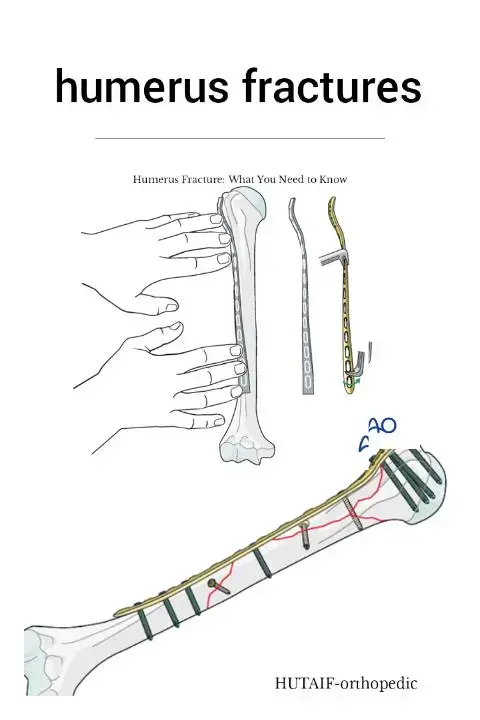 فهم ميكانيكا المسامير النخاعية لتجنب خطر كسر المسمار