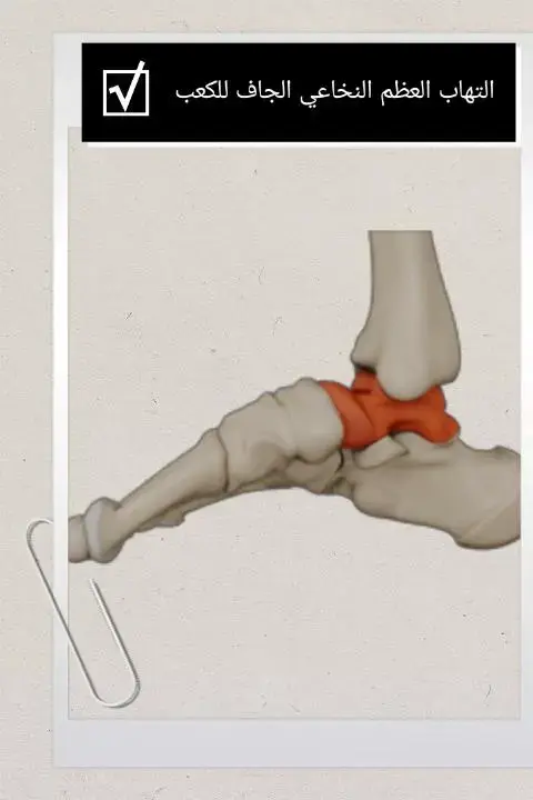 جراحة بناء الرباط الصليبي الأمامي: دليلك الشامل لتعافٍ آمن وسريع