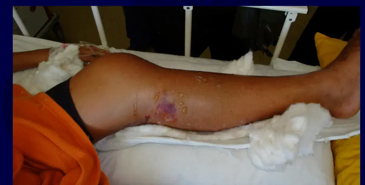 احمِ طفلك: دليل شامل لعلاج مشاكل العظام عند أطفال الشلل الدماغي