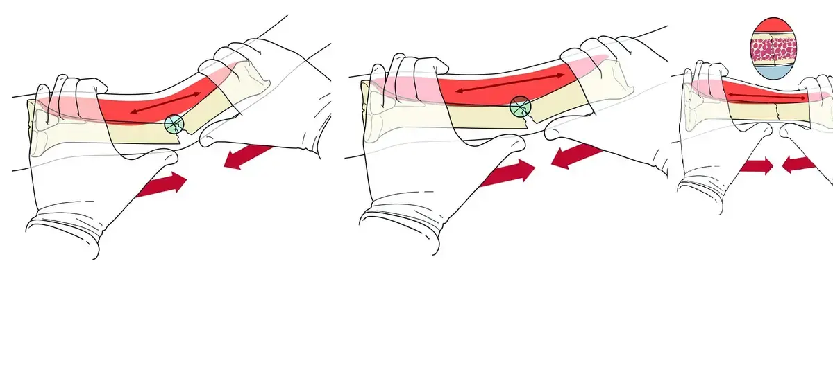 دليلك الشامل: علاج شلل الأطفال بتقويم العظام