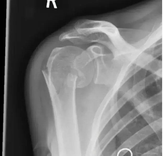 اكتشف: صدمة خلع المرفق – دليل FRCS لامتحان العظام!