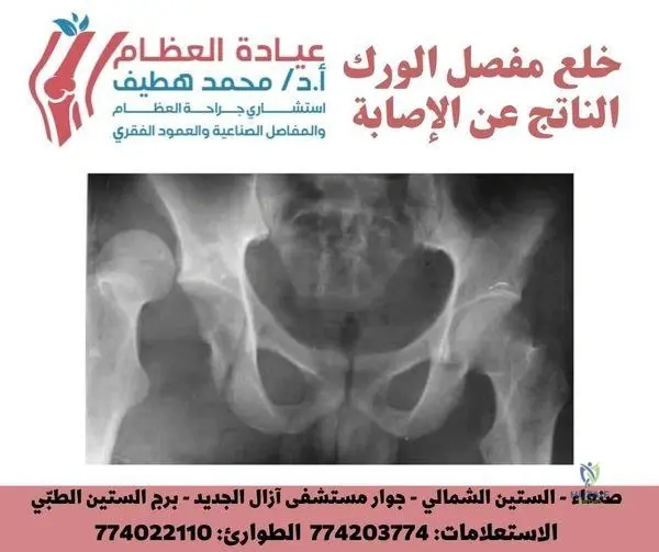 Traumatic Hip Dislocation: Epidemiology, Surgical Anatomy, and Clinical Principles