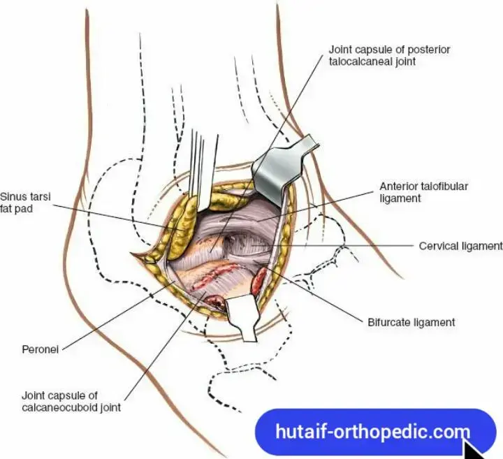 اكتشف: خلع الركبة الولادي - الأعراض، التشخيص، العلاج، والمآل