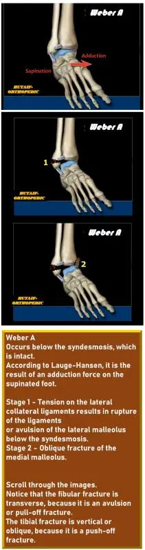 صورة توضيحية لـ كسر الكاحل: دليل شامل للمرضى من التشخيص حتى التعافي مع الأستاذ الدكتور محمد هطيف