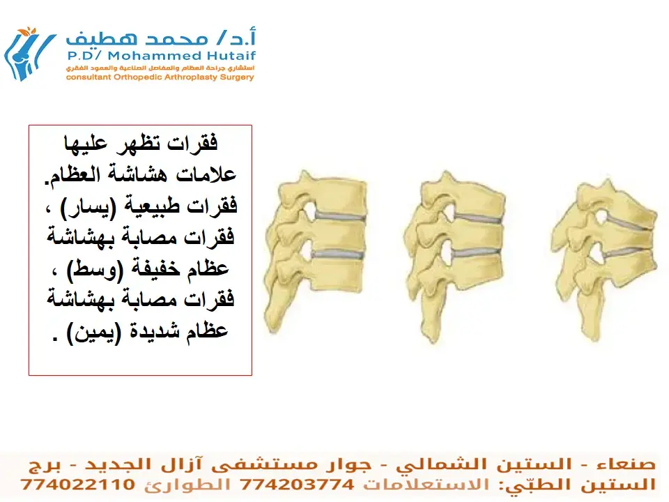 رسم توضيحي وصور جراحية تظهر تفاصيل عملية بتر الربع الأمامي للطرف العلوي، بما في ذلك إزالة لوح الكتف وجزء من الترقوة والأنسجة المحيطة، مع التركيز على حالات الأورام المعقدة.