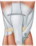 Mastering Knee Arthroplasty: Indications, Biomechanics, and Surgical Principles