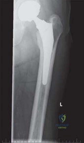 صورة طبية: الرقبة المعيارية Kinectiv® Stem لمفصل الورك الصناعي: حلول متطورة لنجاح جراحة استبدال مفصل الورك مع الأستاذ الدكتور محمد هطيف في صنعاء
