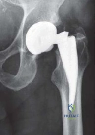 صورة توضيحية لـ الرقبة المعيارية Kinectiv® Stem لمفصل الورك الصناعي: حلول متطورة لنجاح جراحة استبدال مفصل الورك مع الأستاذ الدكتور محمد هطيف في صنعاء