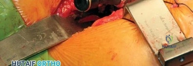 صورة طبية: الرقبة المعيارية Kinectiv® Stem لمفصل الورك الصناعي: حلول متطورة لنجاح جراحة استبدال مفصل الورك مع الأستاذ الدكتور محمد هطيف في صنعاء