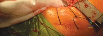 صورة طبية: الرقبة المعيارية Kinectiv® Stem لمفصل الورك الصناعي: حلول متطورة لنجاح جراحة استبدال مفصل الورك مع الأستاذ الدكتور محمد هطيف في صنعاء