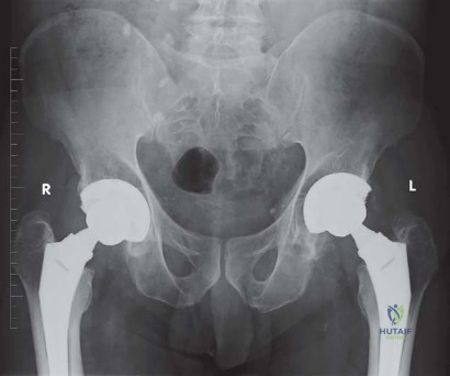 صورة طبية: الرقبة المعيارية Kinectiv® Stem لمفصل الورك الصناعي: حلول متطورة لنجاح جراحة استبدال مفصل الورك مع الأستاذ الدكتور محمد هطيف في صنعاء