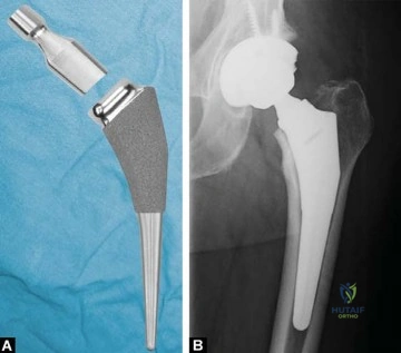 صورة طبية: الرقبة المعيارية Kinectiv® Stem لمفصل الورك الصناعي: حلول متطورة لنجاح جراحة استبدال مفصل الورك مع الأستاذ الدكتور محمد هطيف في صنعاء